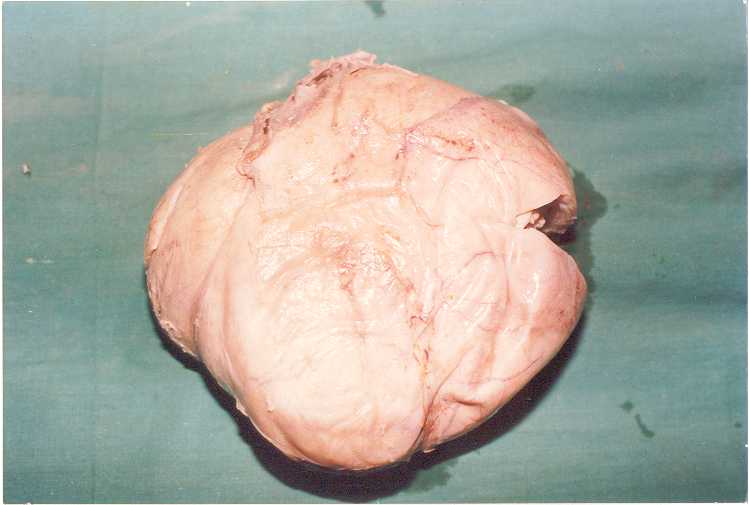 Fibroid Uterus